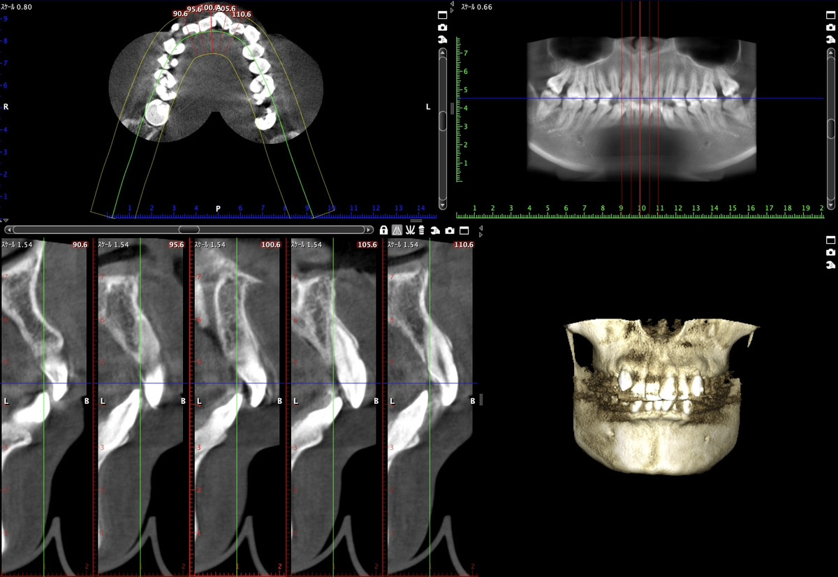 歯科用CT
